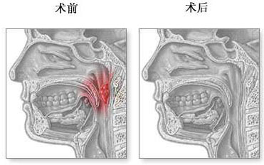 医生分析:家长对腺样体肥大手术的态度误点